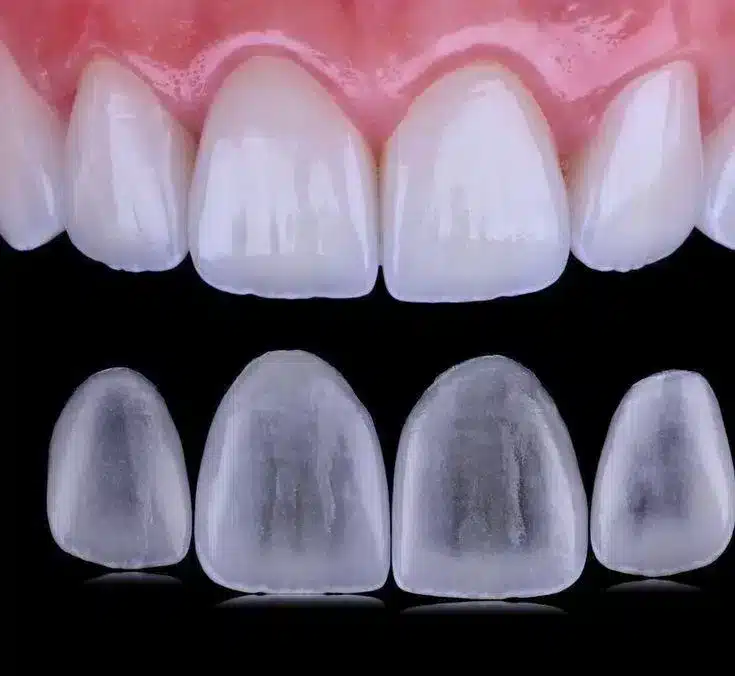 Lentes de Contato Dental: Mitos e Verdades