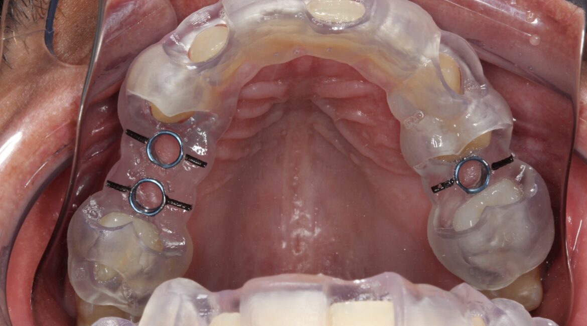 Implantes sem cortes: o que é a cirurgia guiada?