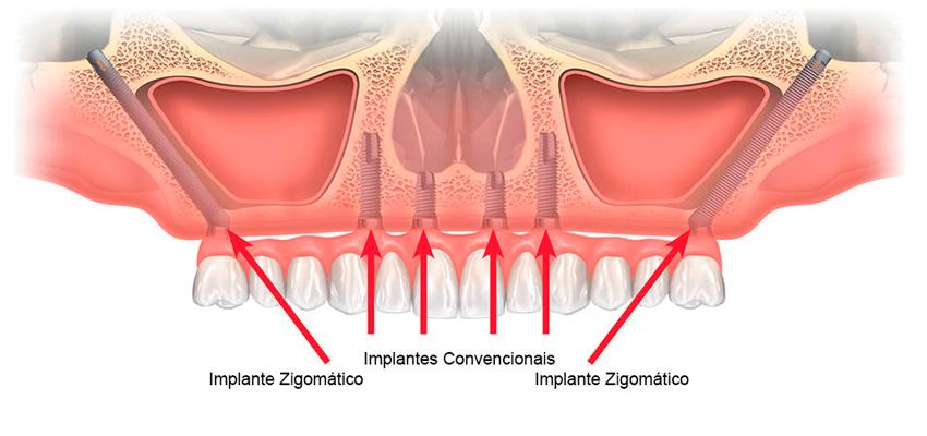 Implantes Zigomáticos: solução avançada para quem não tem osso