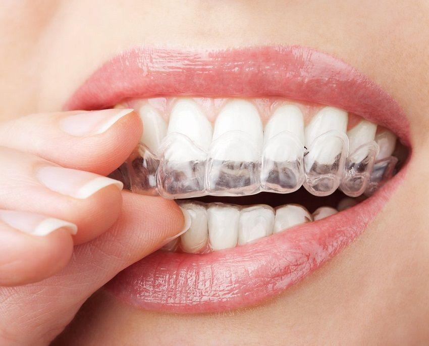 Alinhadores Ortodônticos Invisíveis: tecnologia, conforto e previsibilidade no seu tratamento